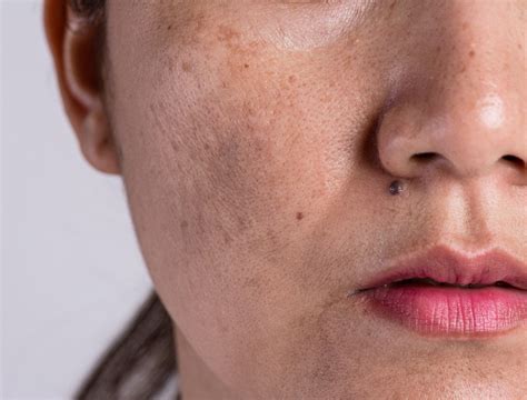 Pigmentation | Symptoms & Causes | Skin Institute