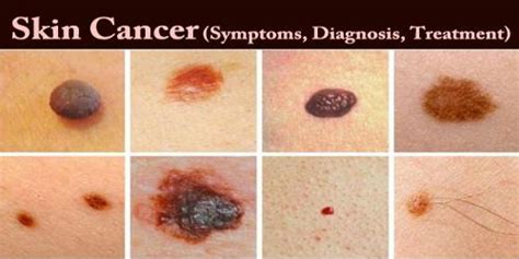 Skin Cancer Signs Treatment : Melanoma Symptoms Pictures Causes And Treatments : Your primary ...