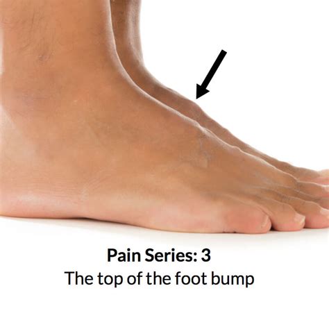 Large Bump On Top Of Foot