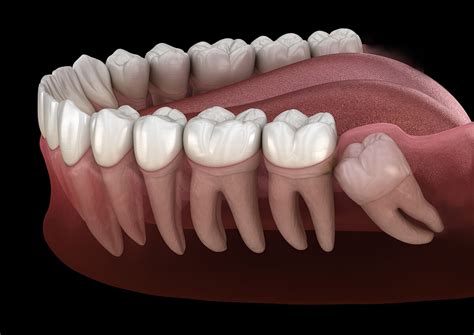 3 Signs You May Need Your Wisdom Teeth Removed - Copier Security