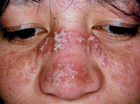 Lupus Skin Rashes In Adults | Images and Photos finder