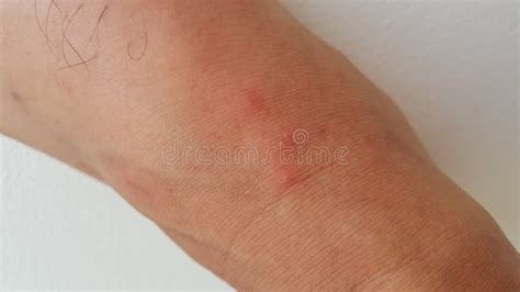 Blisters on a Legs after Ant Bite Solenopsis Geminata ,tropical Fire Ant. Stock Image - Image of ...