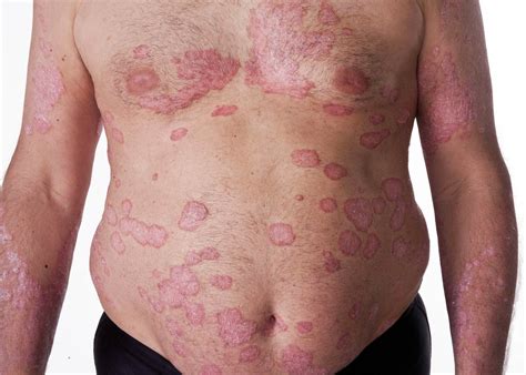 Natural Psoriasis Treatment Program - The Psoriasis Program