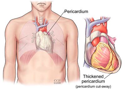 Pericardiectomy | Cleveland Clinic