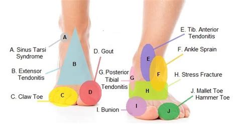 Foot Pain Diagram - Why Does My Foot Hurt?