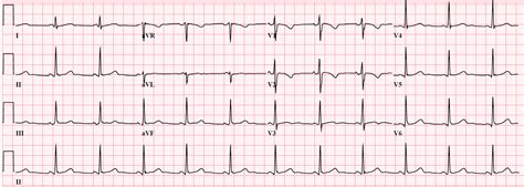 Dr. Smith's ECG Blog: T-wave inversion in a young woman with ...