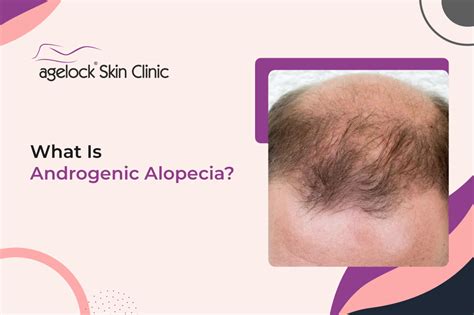 What Is Androgenic Alopecia? Causes, Treatment & Side Effects - Agelock Skin Clinic