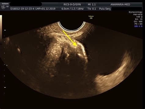 Ultrasound diagnosis of bladder endometriosis [Dec 2022] – EFSUMB