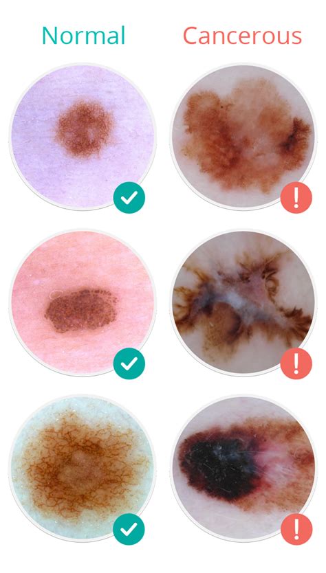 Melanoma Skin Moles