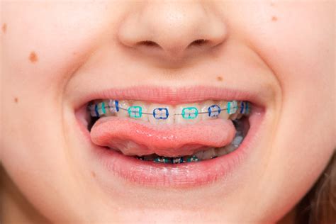 Ultimate Guide to Braces for Kids - Best Dental Care for Kids