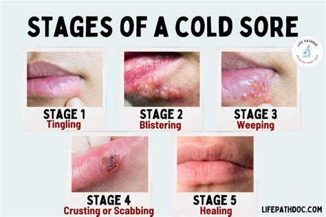 Cold Sore Stages, with Pictures