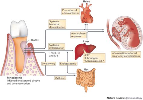 The Link Between Gum Disease and Heart Disease