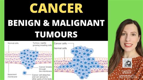 Benign Tumor Vs Malignant Tumor Know The Fact Indo 2