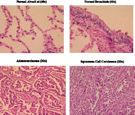 Malignant Tumor Histology