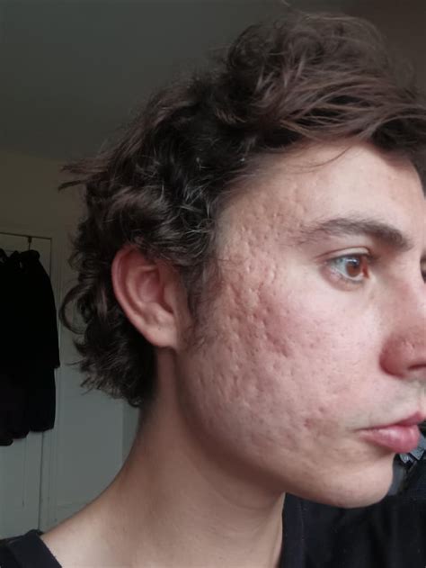 First week of purging on differin gel : acne