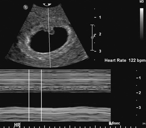 Ultrasound Series: Part 3 Heartbeat - Crossroads Pregnancy Center