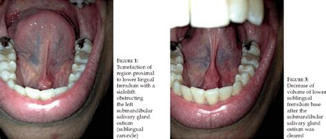 Sublingual Caruncle | News | Dentagama