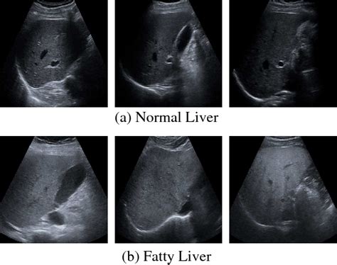 Fatty Liver In Ultrasound - Herbs and Food Recipes