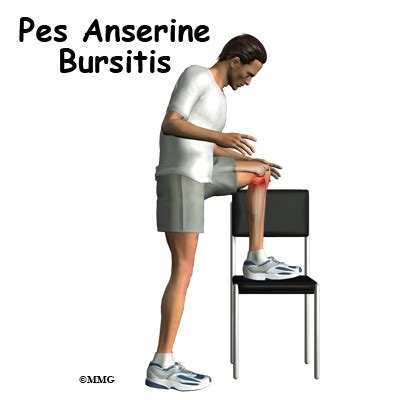 Pes Anserine Bursitis of the Knee - Orthopedic Surgery, Algonquin, IL, Barrington, IL, Elgin, IL ...