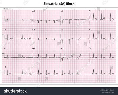 Sinoatrial Sa Block Ecg Paper 12 Stock Vector (Royalty Free) 2270493547 ...