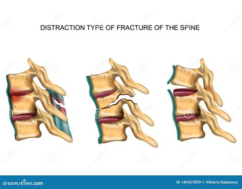 Distraction Type of Fracture of the Spine Stock Vector - Illustration of anatomy, medical: 145427859