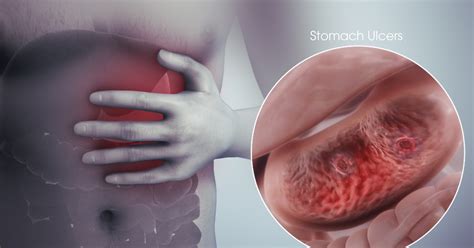 Online Medical Help india: Stomach Ulcers- Symptoms, Causes And Diagnosis