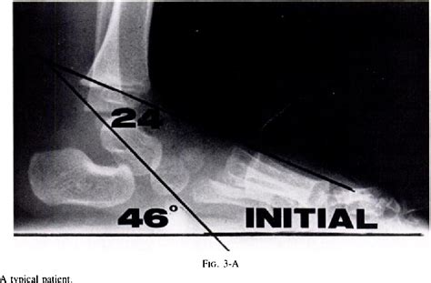 Talipes Calcaneovalgus | Semantic Scholar