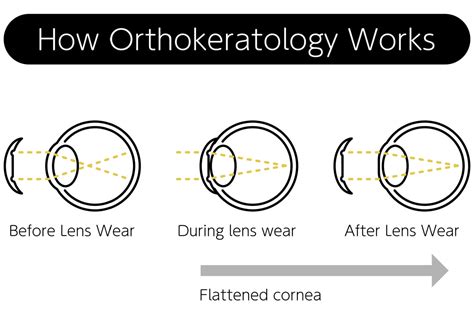 Ortho-K Lenses: Everything You Need to Know | Plainville