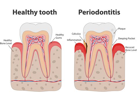 What is a Periodontal Pocket?