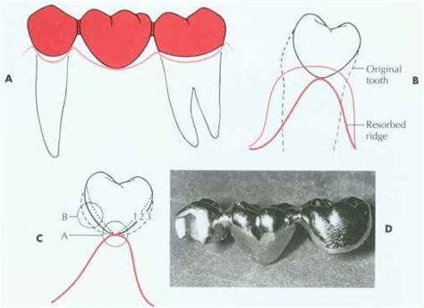 Ovate Pontic - Tooth Structure - Mussen Healthcare