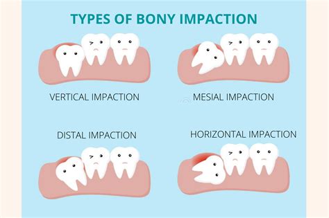 Impacted Wisdom Teeth