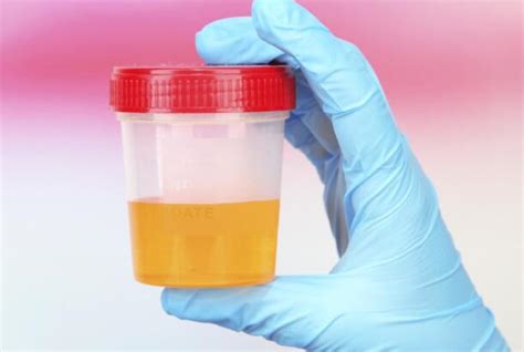 Brown Urine - Symptoms, Causes, Treatments | Healthgrades.com