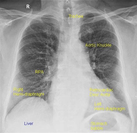 X-ray Chest PA View (CXR-PA) – All About Cardiovascular System and Disorders