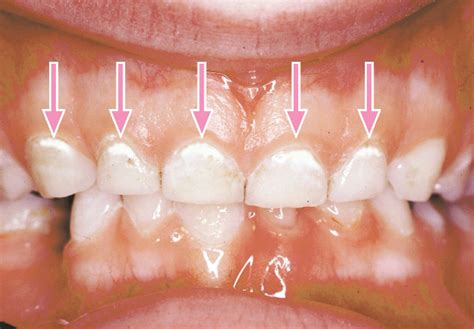 Tooth Decay In Baby Teeth Treatment - TeethWalls