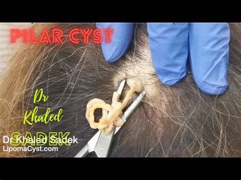 Pilar Cyst Removal. London.Dr Khaled Sadek. LipomaCyst.com - YouTube ...