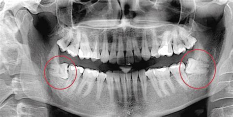 wisdom teeth recovery guide