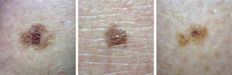 What does melanoma look like? - MoleMap