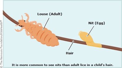 What Are Head Lice? (for Kids) | Nemours KidsHealth