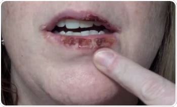 Photos Of Skin Cancer On Lips | Lipstutorial.org