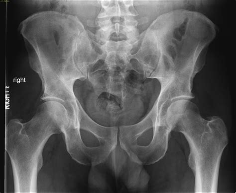 AP pelvis radiograph | NucsRadiology.com