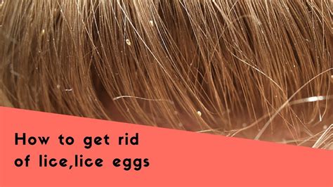 Home Remes For Head Lice Eggs Removal - Homemade Ftempo