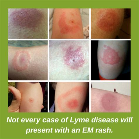 Lyme Disease UK - a brief explanation of Lyme disease in the UK