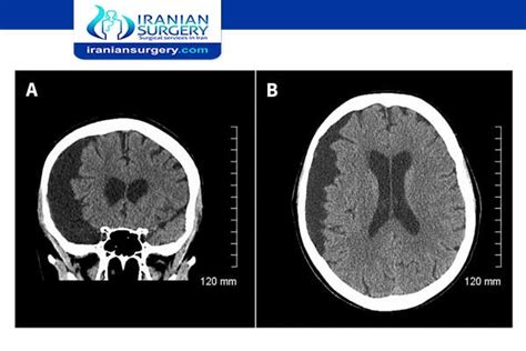 Arachnoid cyst treatment | Arachnoid cyst treatment without surgery