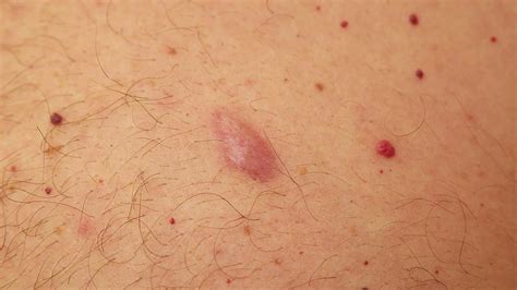 Painful Pea Sized Lump In Armpit - 13 Home Remedies To Reduce Armpit Lumps : A lump in the ...