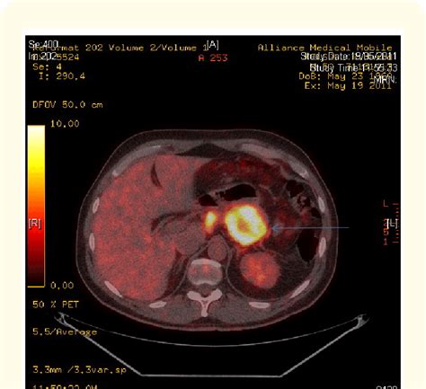 What Is A Pet Ct Scan For Cancer