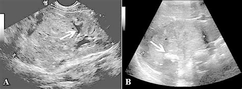 Wilms Tumor Symptoms, Prognosis, Treatment, Causes