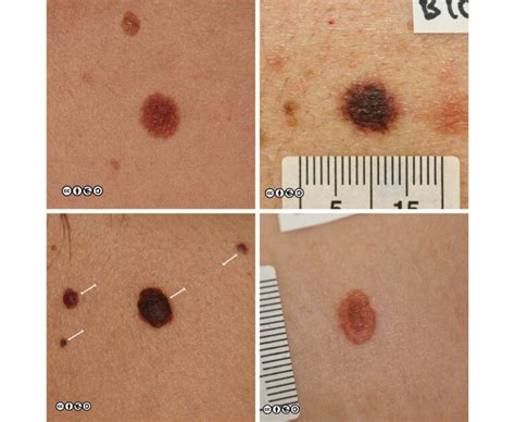 Melanoma images early stages, melanoma pictures early stages, early melanoma pictures, what does ...