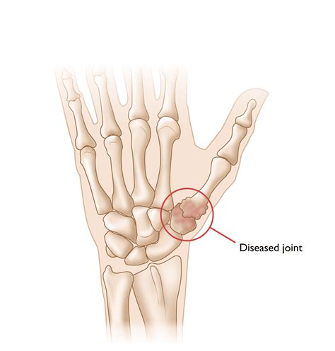 Arthritis of the Thumb - OrthoInfo - AAOS