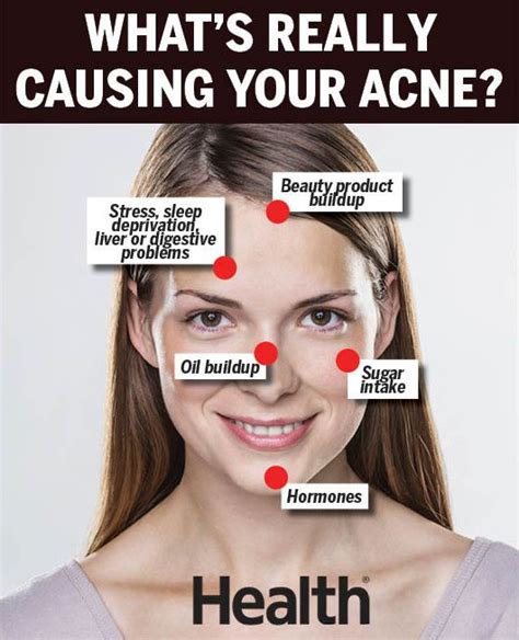 Chin, Cheek, Forehead Acne: What's Causing Breakouts?