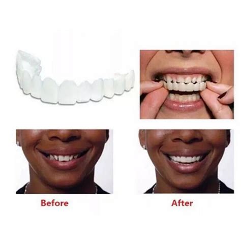 Instant perfect smile veneers